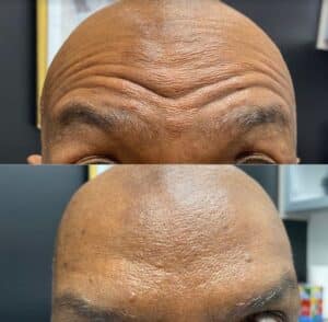 Botox forehead - before and after photos