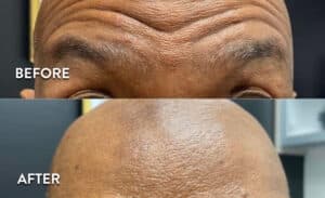 Botox before and after photos