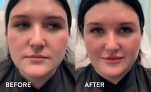 Lip Filler before and after photos