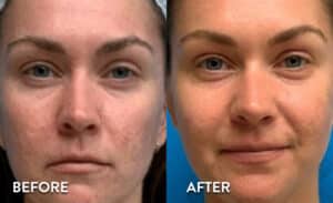 Chemical Peel Before & After