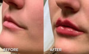 Lip Filler before and after photos