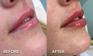 Lip Filler before and after photos