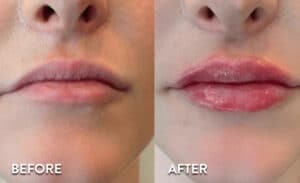 Lip Filler before and after photos