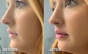 Lip Filler before and after photos