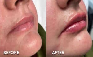Lip Filler before and after photos