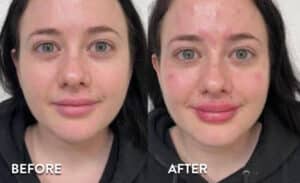 Lip Filler before and after photos