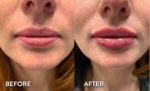 Lip Filler before and after photos