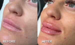 Lip Filler before and after photos