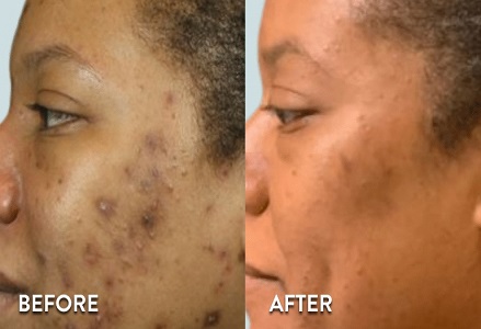 VI Peels Before & After Photos