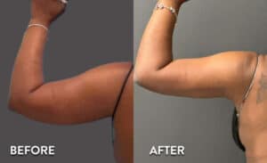 Smartlipo Before-After Photos Arms