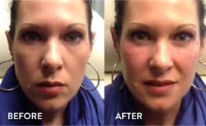 Juvederm Voluma Before & After