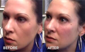 Juvederm Voluma Before & After