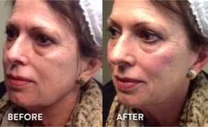Juvederm Voluma Before & After