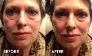 Juvederm Voluma Before & After