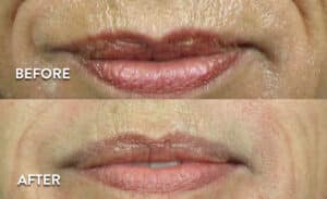 Juvederm XC Before & After Pictures