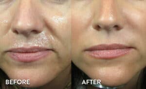 Juvederm XC Before & After Pictures