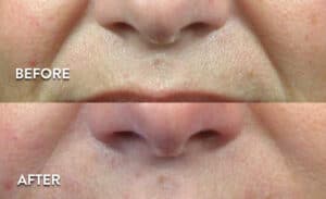 Juvederm XC Before & After Pictures
