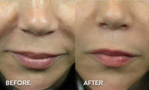 Juvederm XC Before & After Pictures