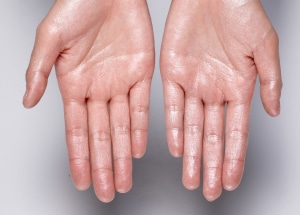 Can miraDry® Be Used for Feet and Hands?