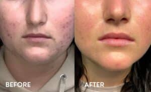 VI Peel Before and After Photos