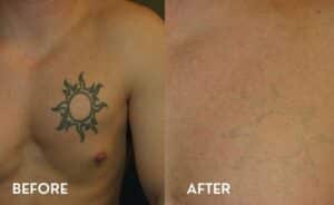 Laser Tattoo Removal Atlanta - Before and After Photos