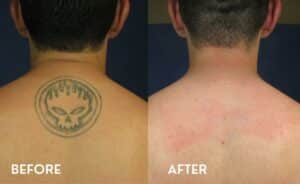 Laser Tattoo Removal Atlanta - Before and After Photos
