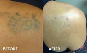 Laser Tattoo Removal Atlanta - Before and After Photos