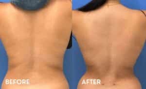 Smartlipo 360 in Atlanta - Before and After Photos