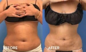 Smartlipo 360 in Atlanta - Before and After Photos