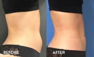 Getting Smartlipo in Atlanta - Before and After Photos Abdomen