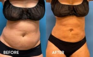 Getting Smartlipo in Atlanta - Before and After Photos Abdomen