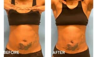 Getting Smartlipo in Atlanta - Before and After Photos Abdomen