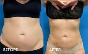 Getting Smartlipo in Atlanta - Before and After Photos Abdomen