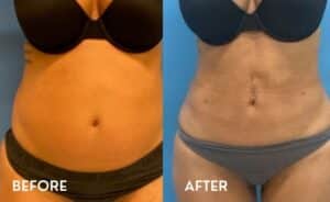 Getting Smartlipo in Atlanta - Before and After Photos Abdomen