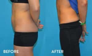 Getting Smartlipo in Atlanta - Before and After Photos Abdomen