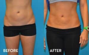 Getting Smartlipo in Atlanta - Before and After Photos Abdomen