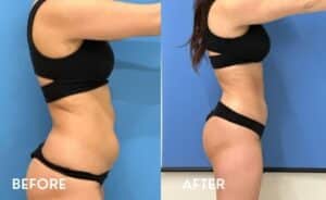 Smartlipo Flanks & Abdomen side - Before and After Photos