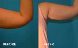 Smartlipo Before-After Photos Arms