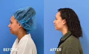 Smartlipo Chin - Before and After photos