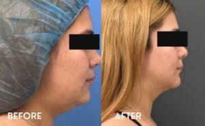 Smartlipo Chin - Before and After photos