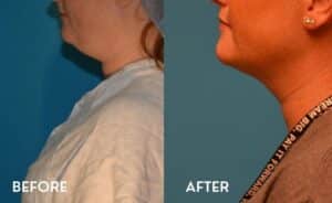 Smartlipo Chin - Before and After photos