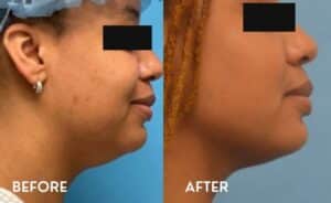 Smartlipo Chin - Before and After photos