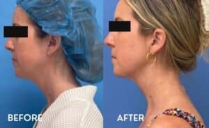 Smartlipo Chin - Before and After photos