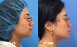 Smartlipo Chin - Before and After photos