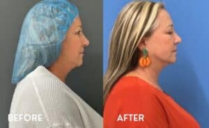 Smartlipo Chin - Before and After photos