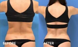 Smartlipo Flanks back - Before and After Photos