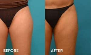 Smartlipo for outer thighs - Before and After Photos