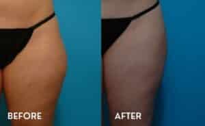 Smartlipo for outer thighs - Before and After Photos