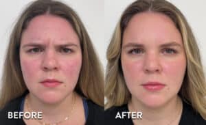 Botox glabella - before and after photos