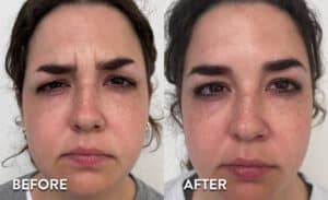 Botox forehead - before and after photos